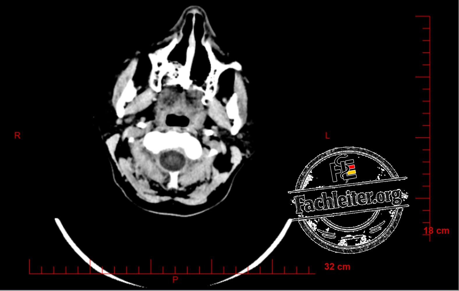 Brain (Hirnfenster)