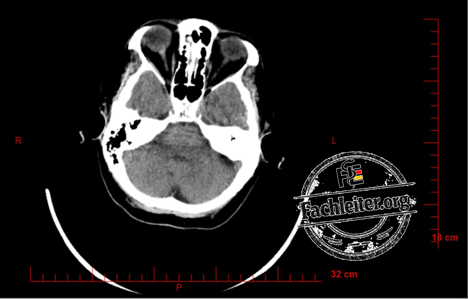 Brain (Hirnfenster) 10