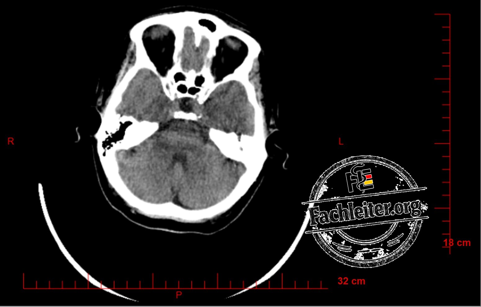 Brain (Hirnfenster) 11
