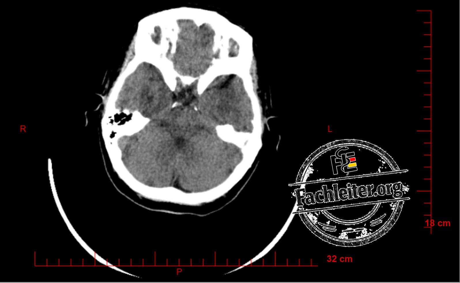 Brain (Hirnfenster) 12