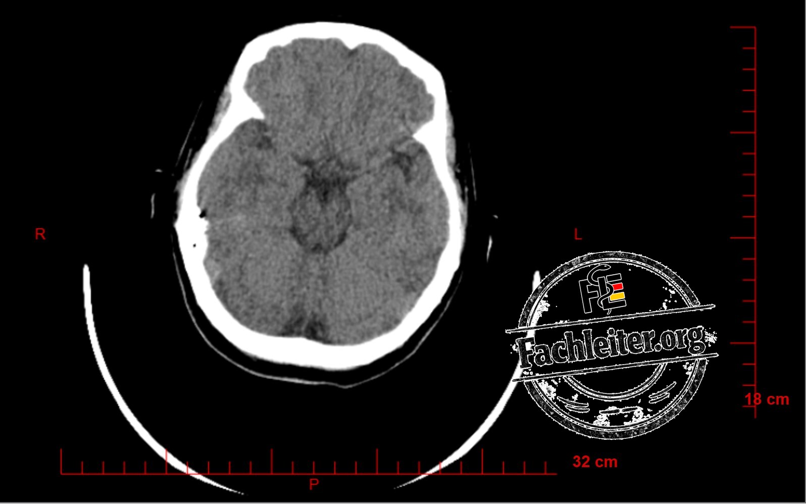 Brain (Hirnfenster) 13