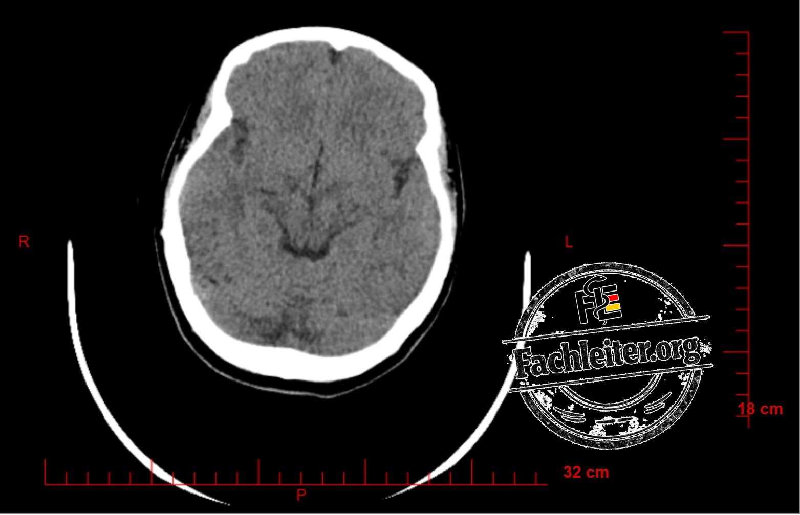 Brain (Hirnfenster) 14