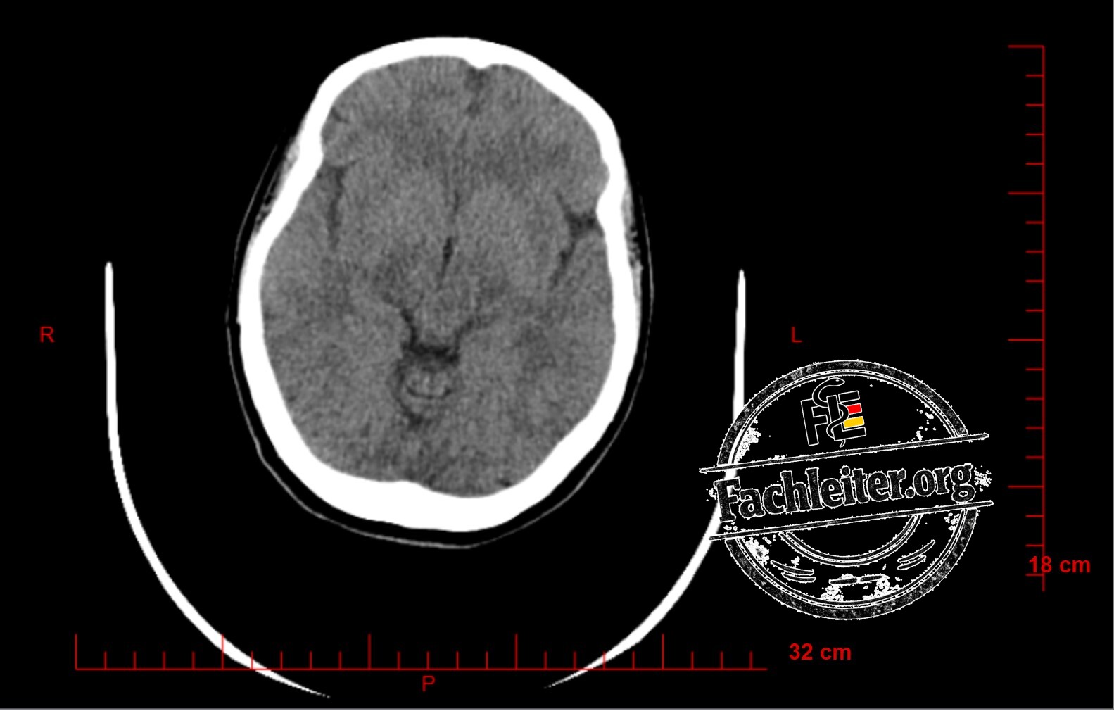 Brain (Hirnfenster) 15