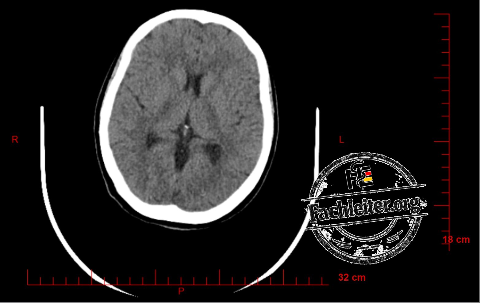 Brain (Hirnfenster) 17
