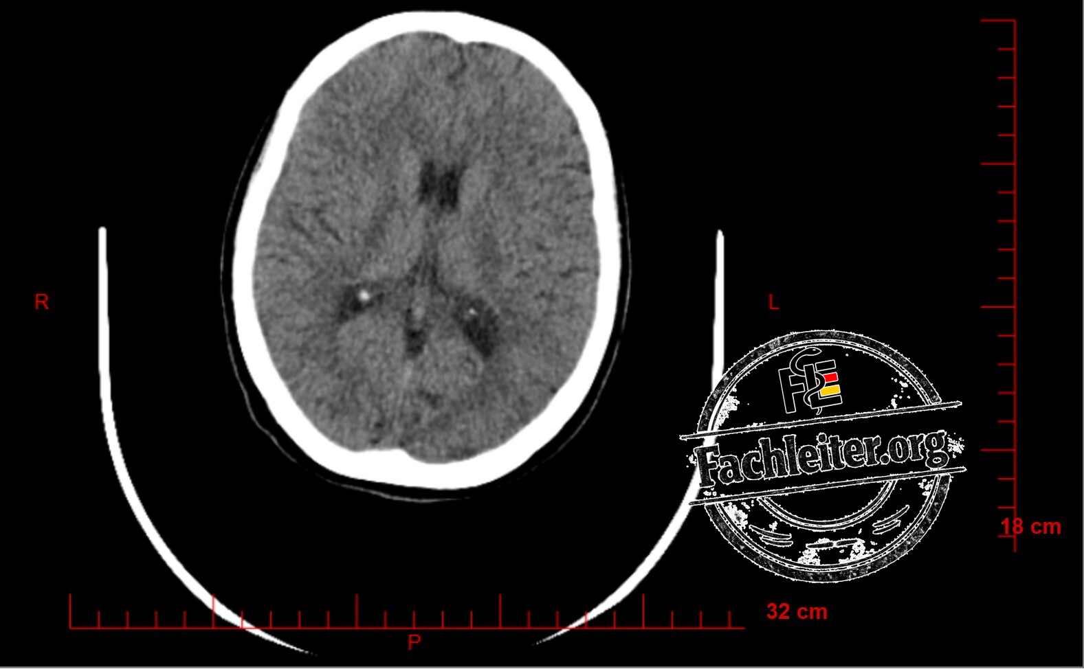 Brain (Hirnfenster) 18
