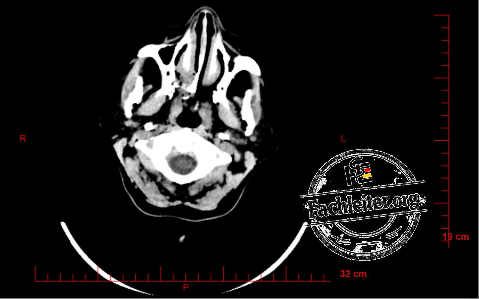 Brain (Hirnfenster) 2
