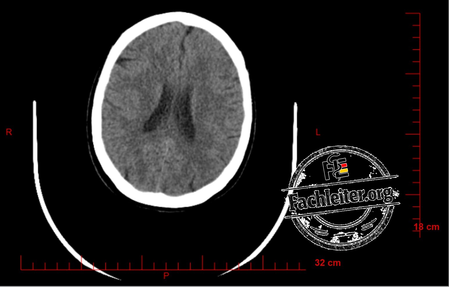 Brain (Hirnfenster) 20