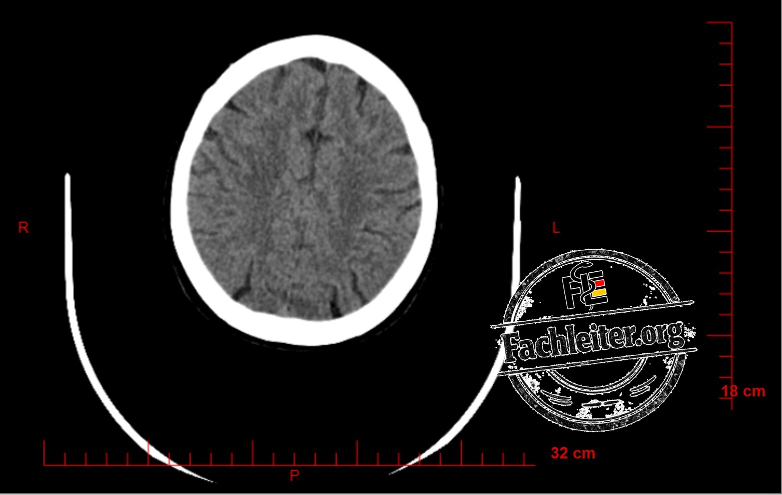 Brain (Hirnfenster) 23
