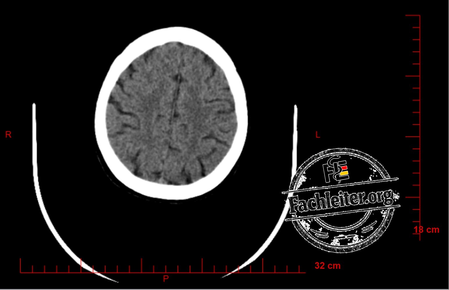 Brain (Hirnfenster) 24
