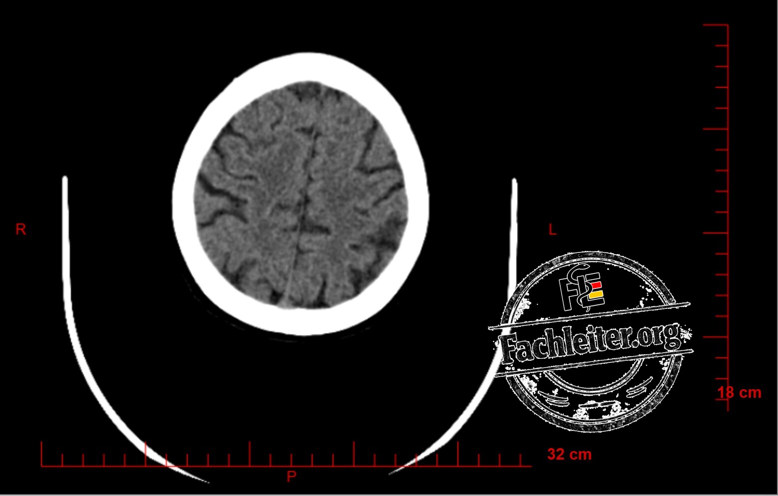 Brain (Hirnfenster) 25