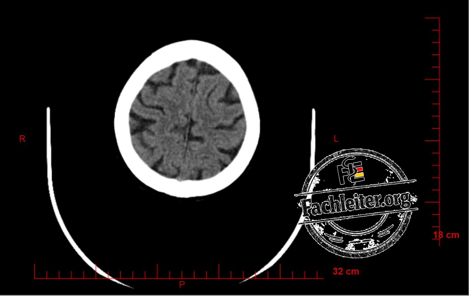 Brain (Hirnfenster) 26