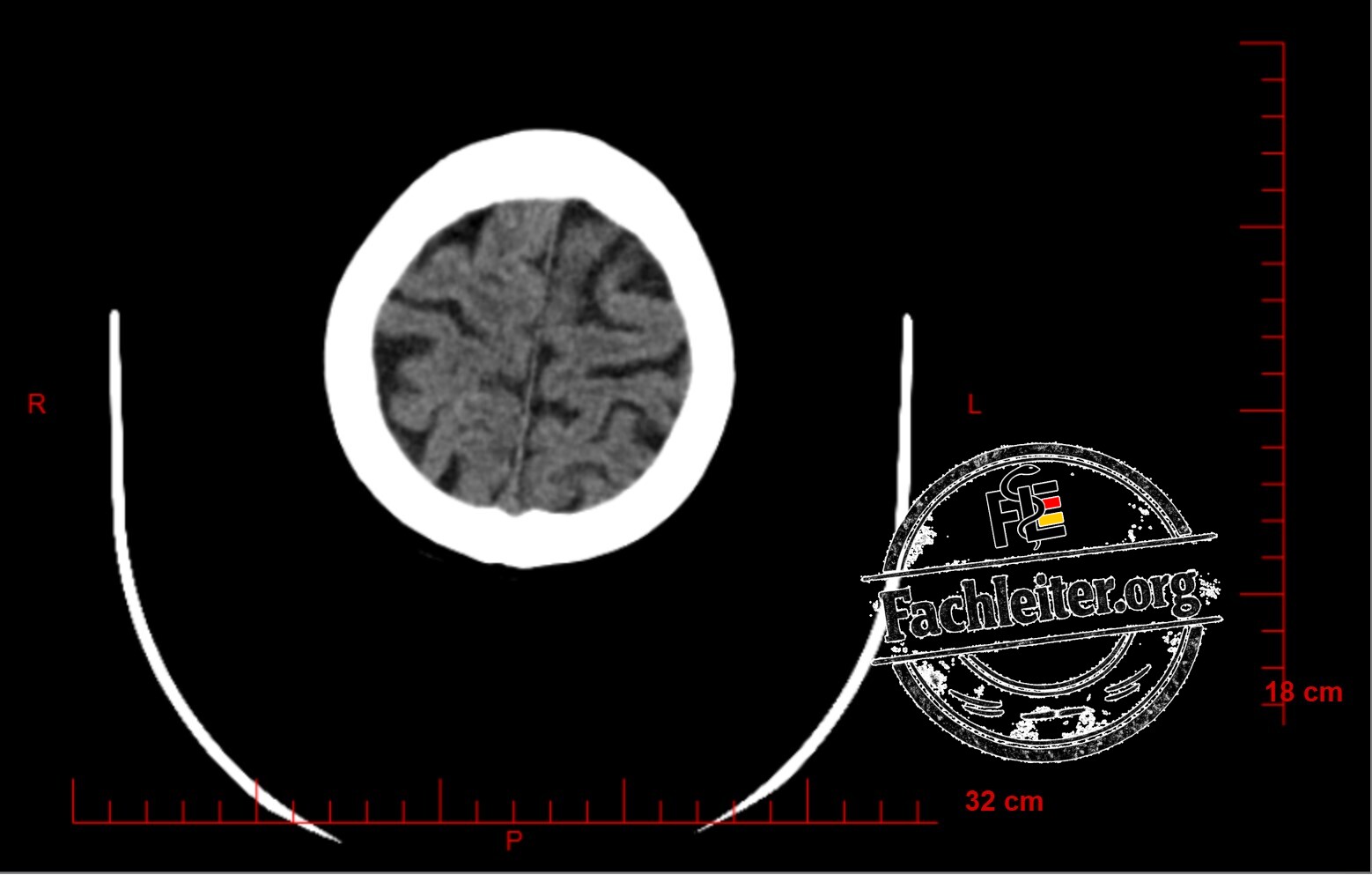 Brain (Hirnfenster) 27