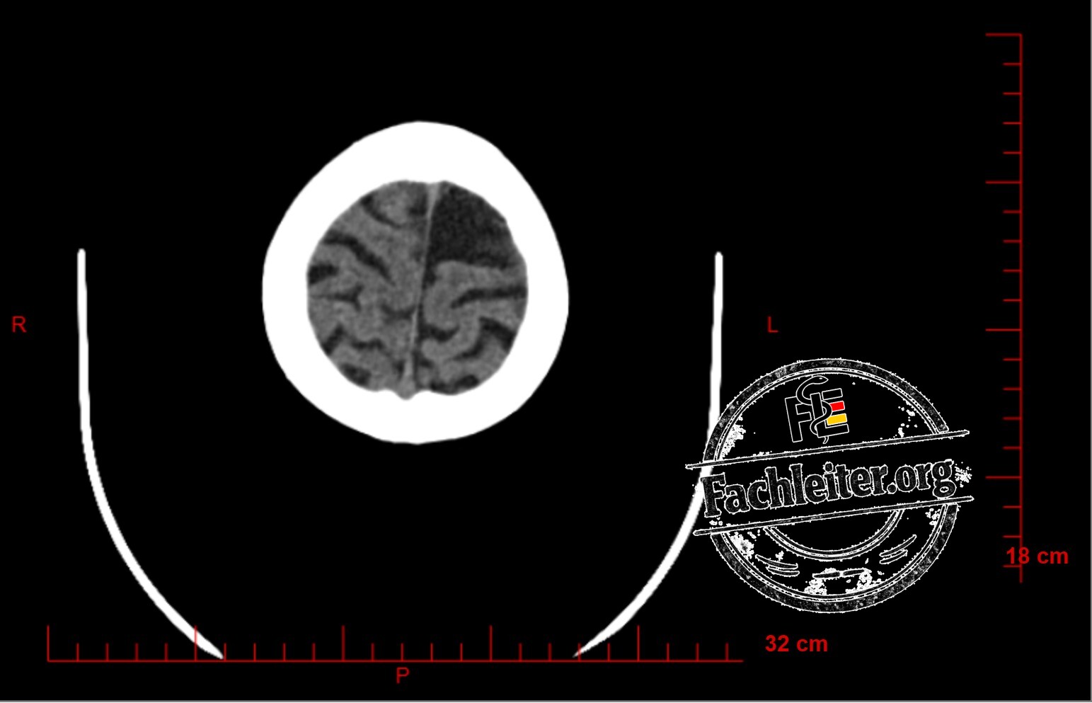 Brain (Hirnfenster) 28
