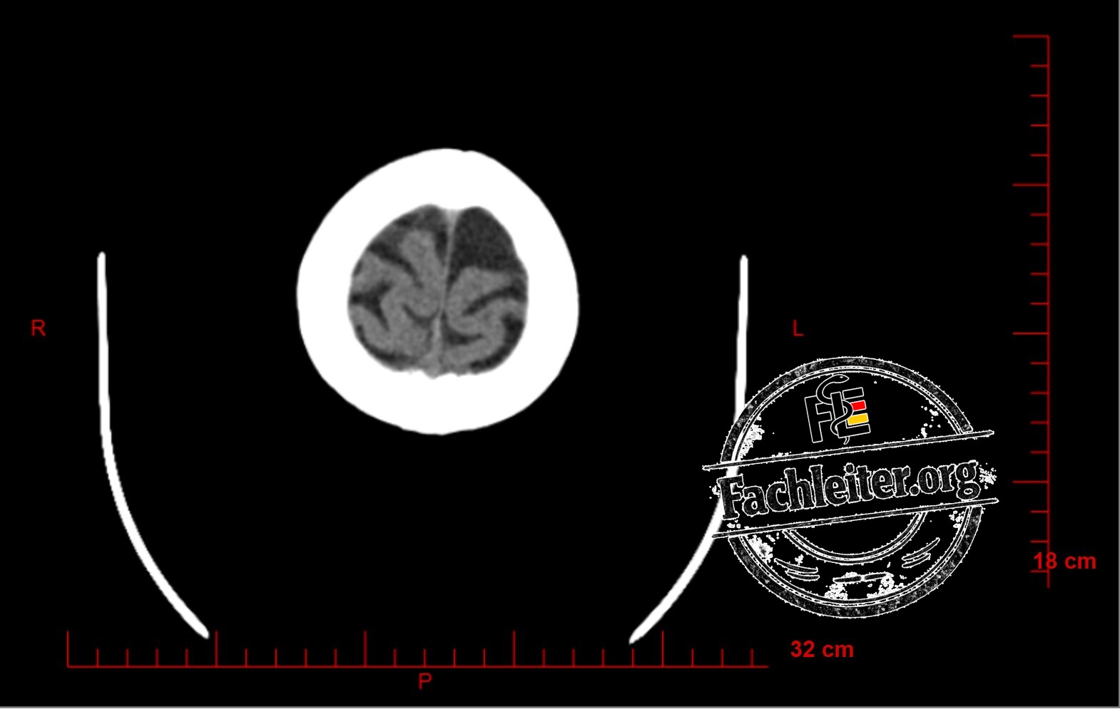 Brain (Hirnfenster) 29