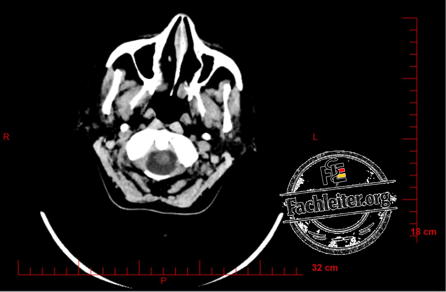Brain (Hirnfenster) 4