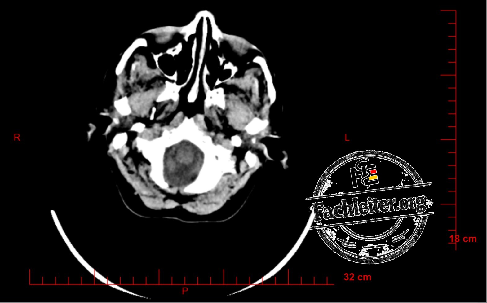 Brain (Hirnfenster) 5