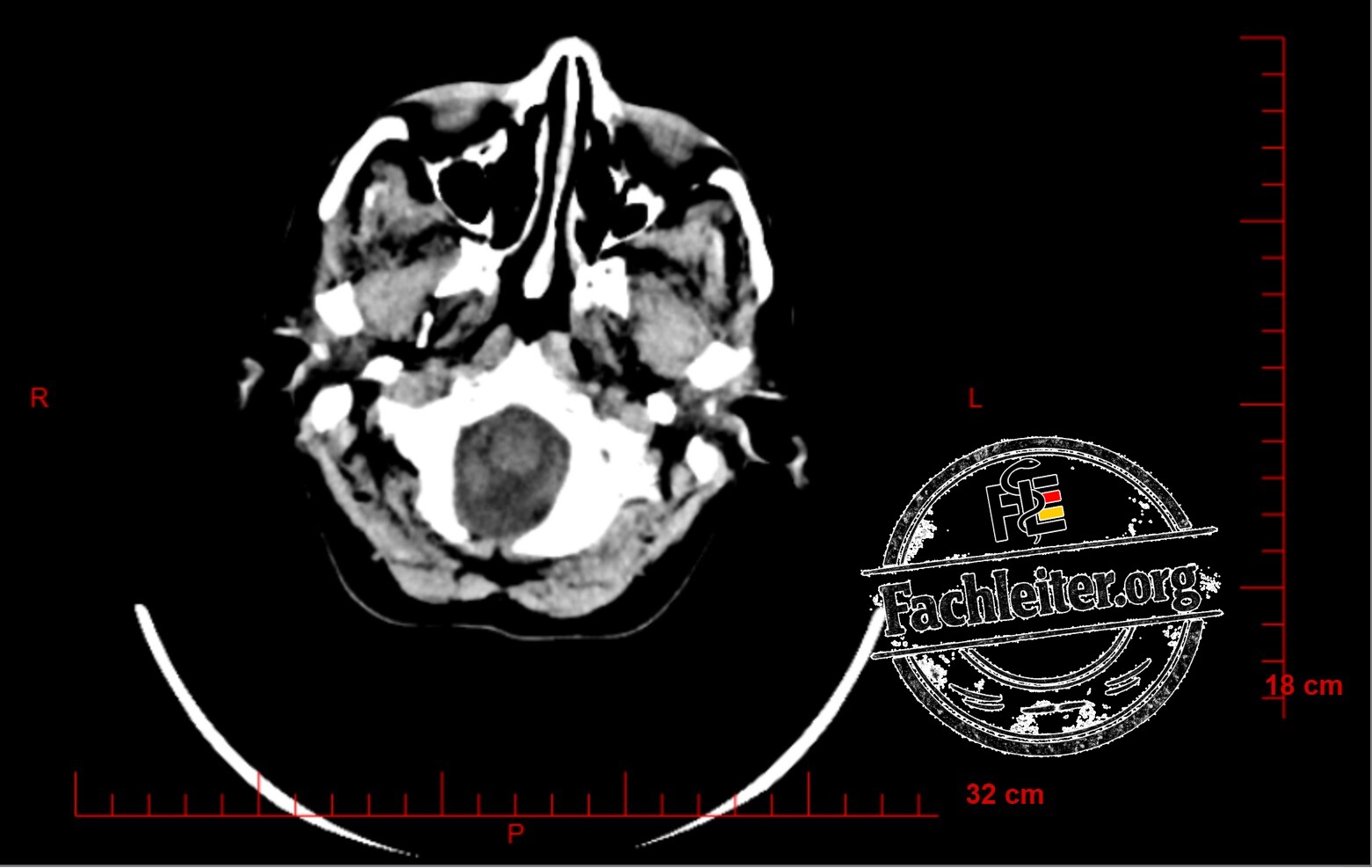Brain (Hirnfenster) 6