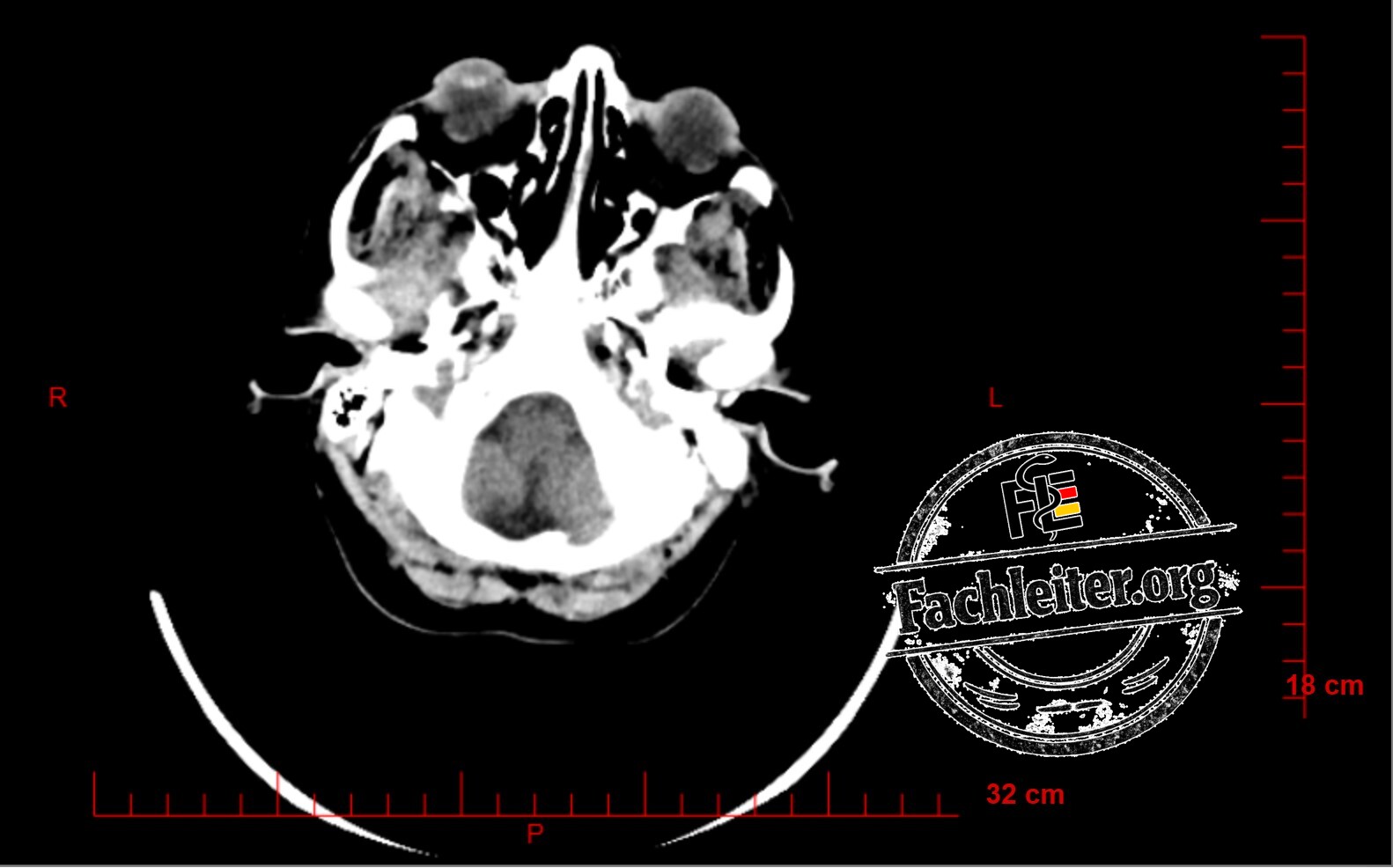 Brain (Hirnfenster) 7
