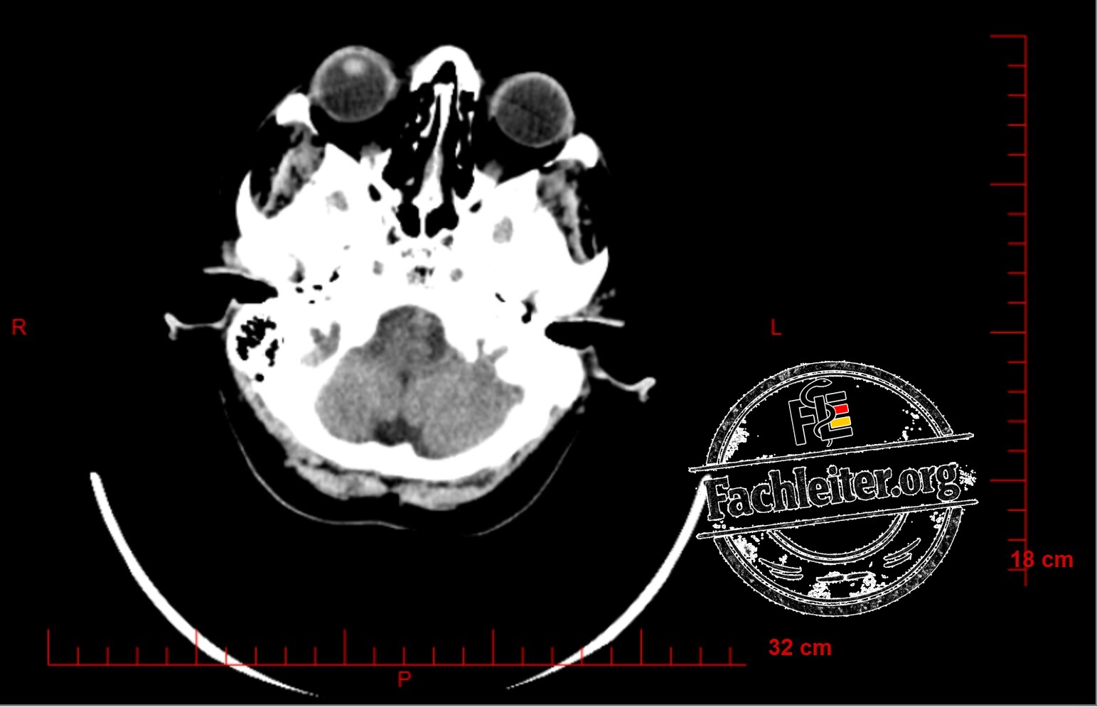 Brain (Hirnfenster) 8