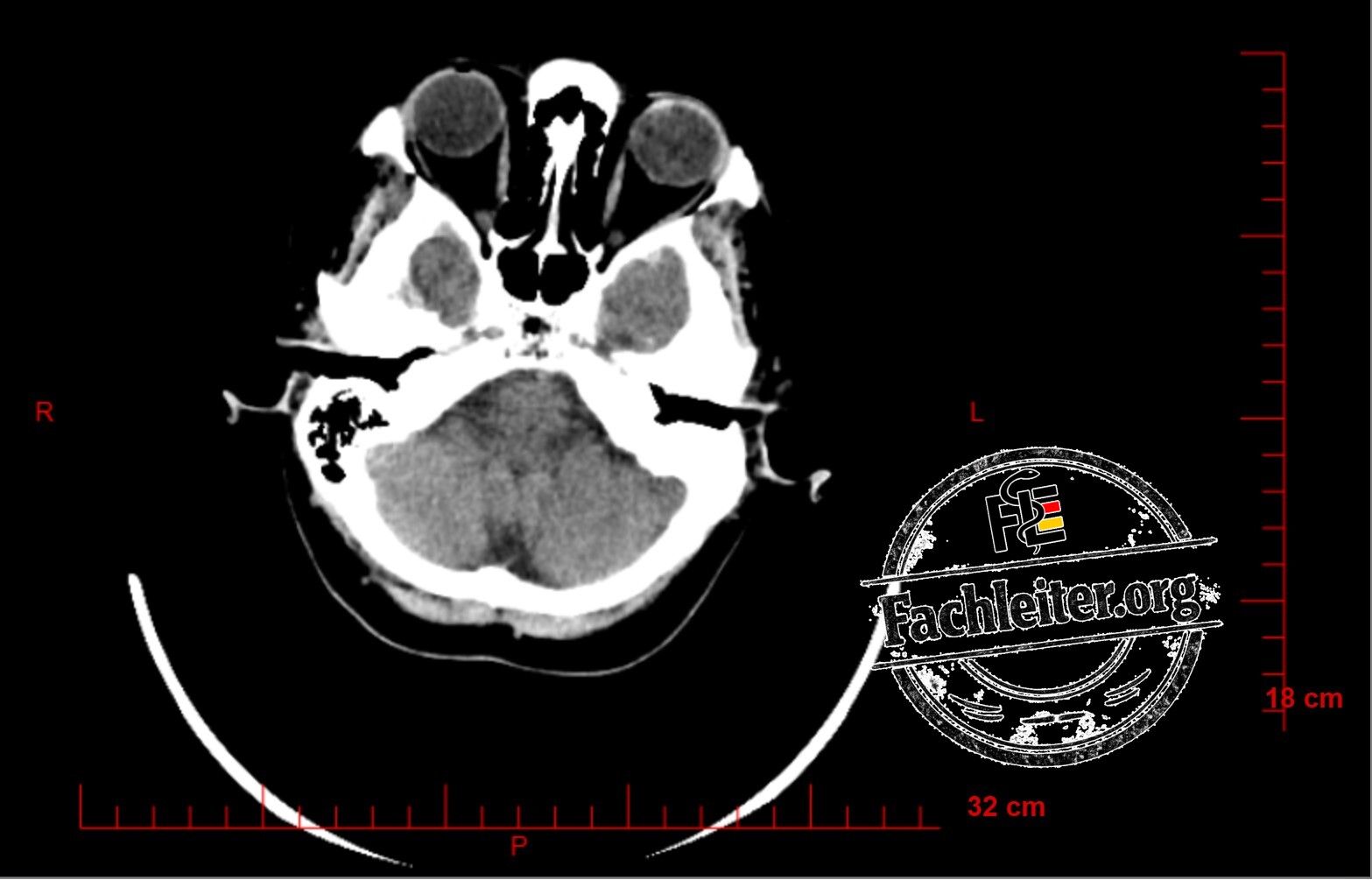 Brain (Hirnfenster) 9