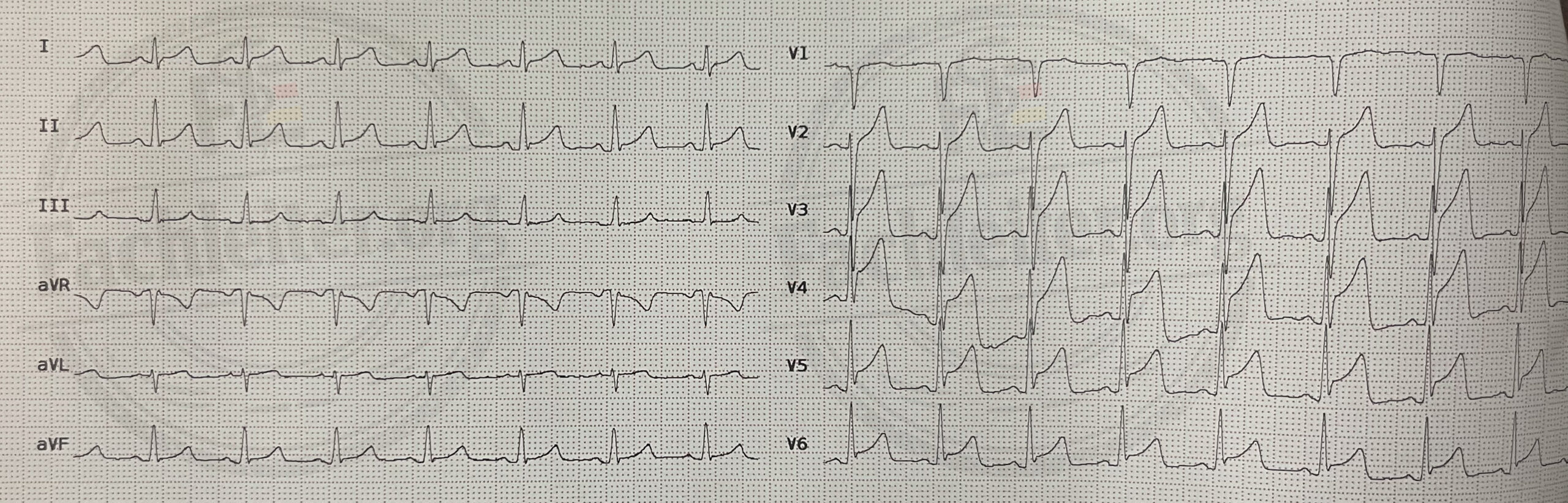 ST-Hebung (anterior)