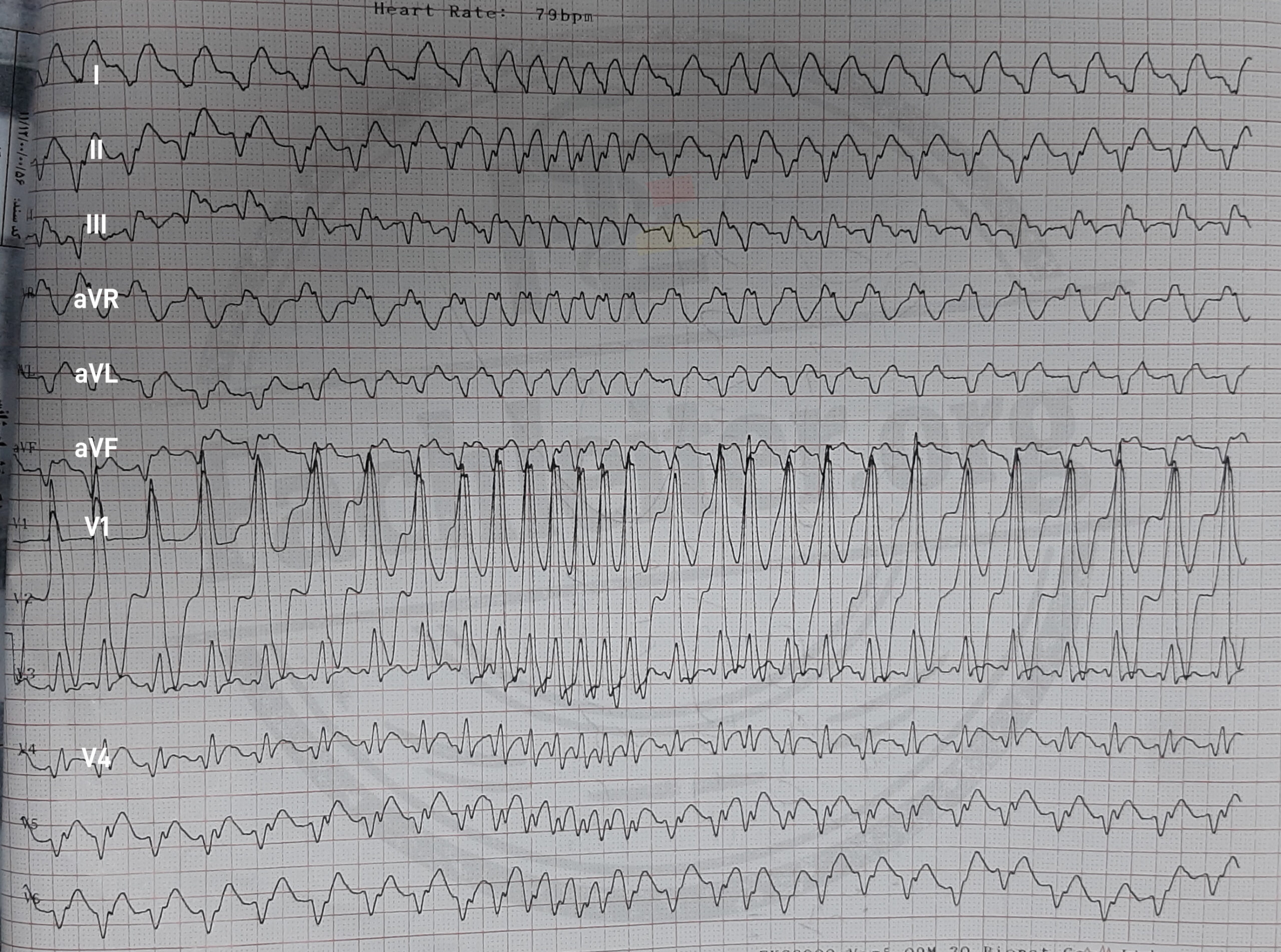 das erste EKG