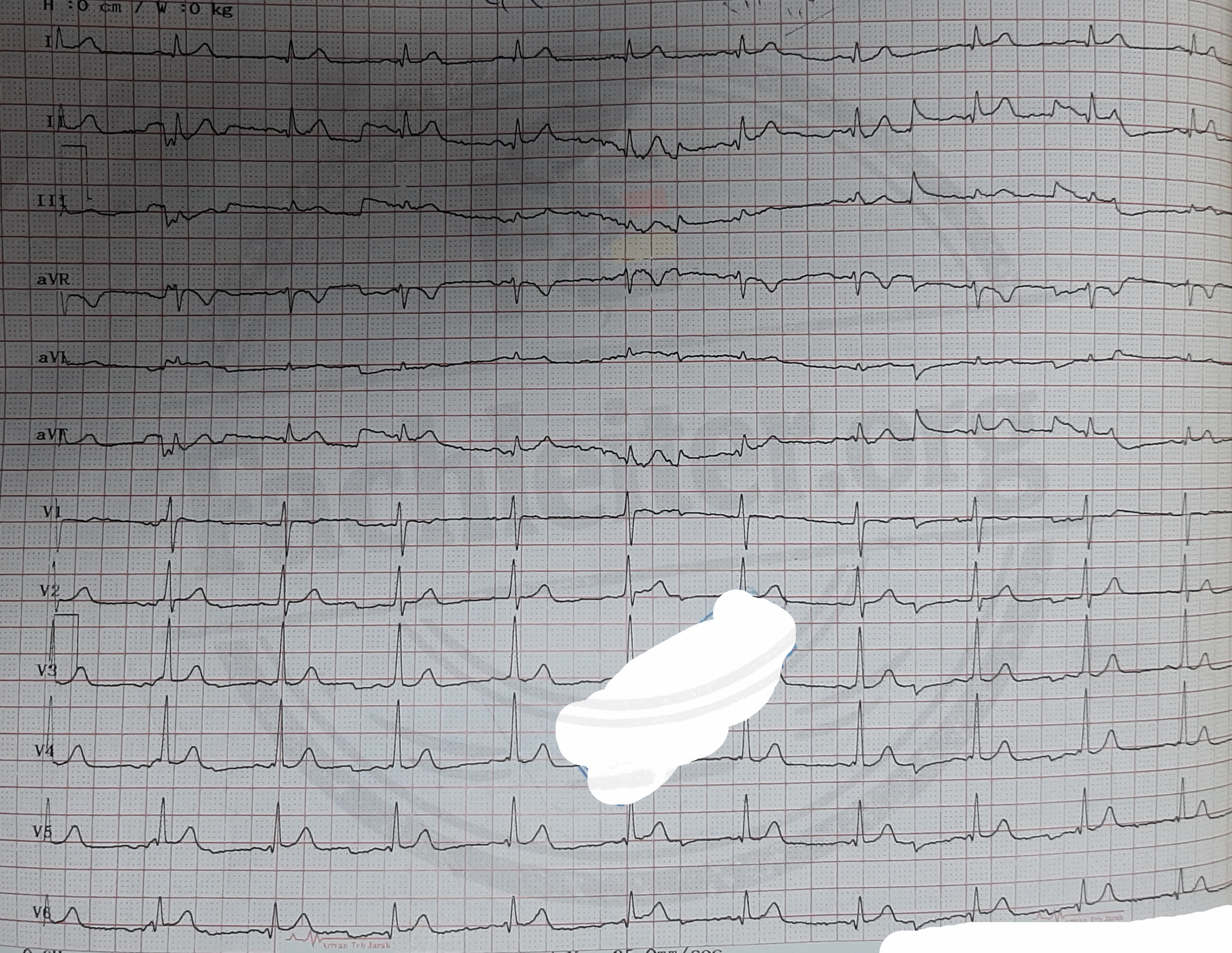 das zweites EKG