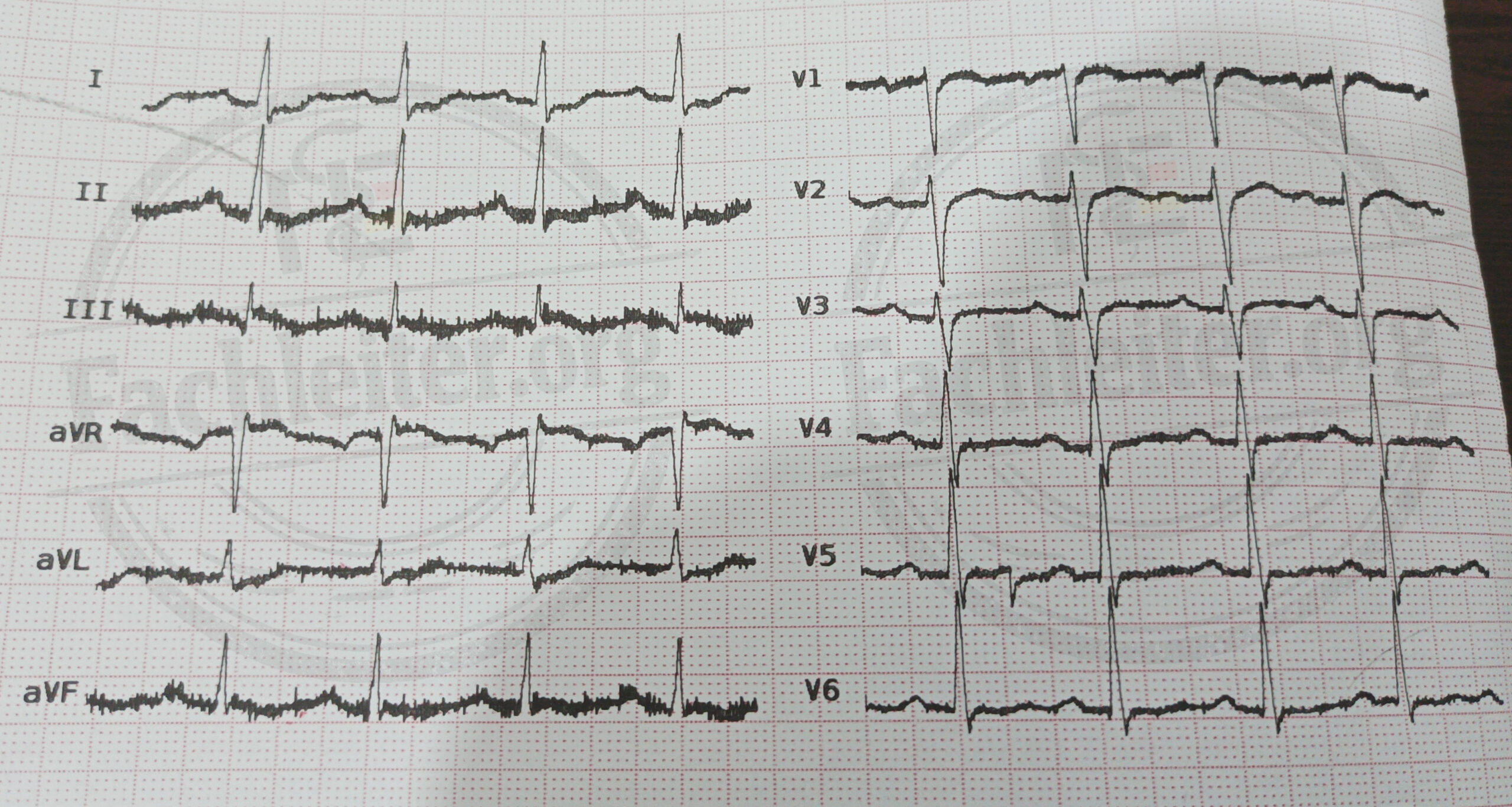 Zweites EKG
