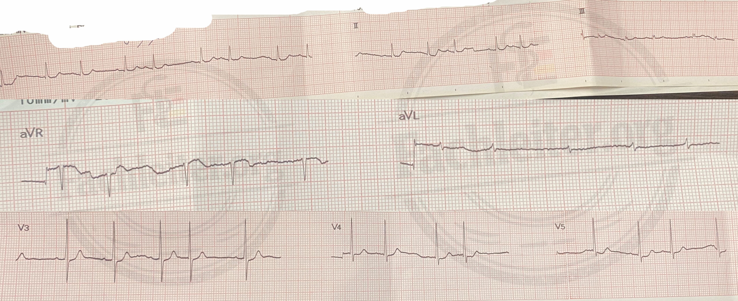 EKG 1