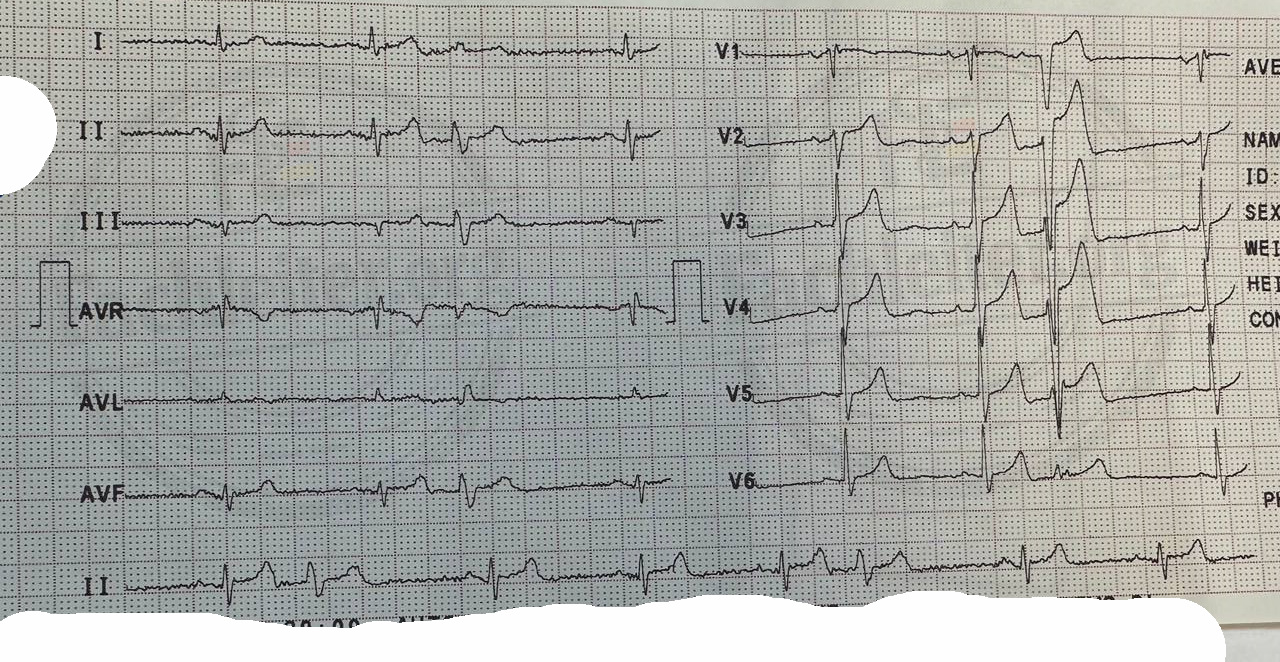 EKG 2