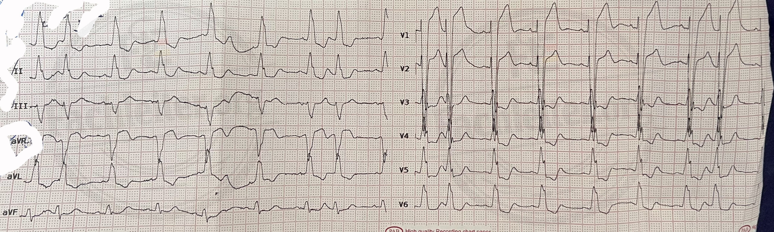 EKG 3