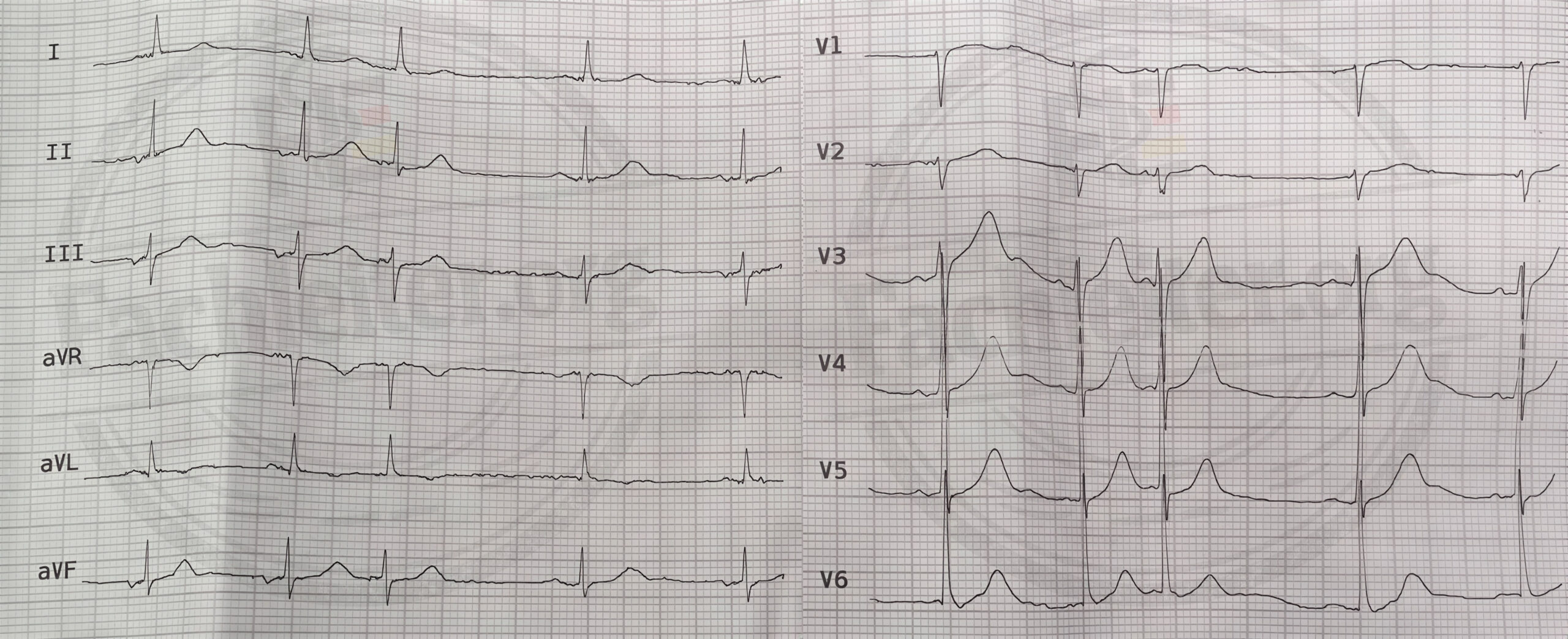 EKG 4