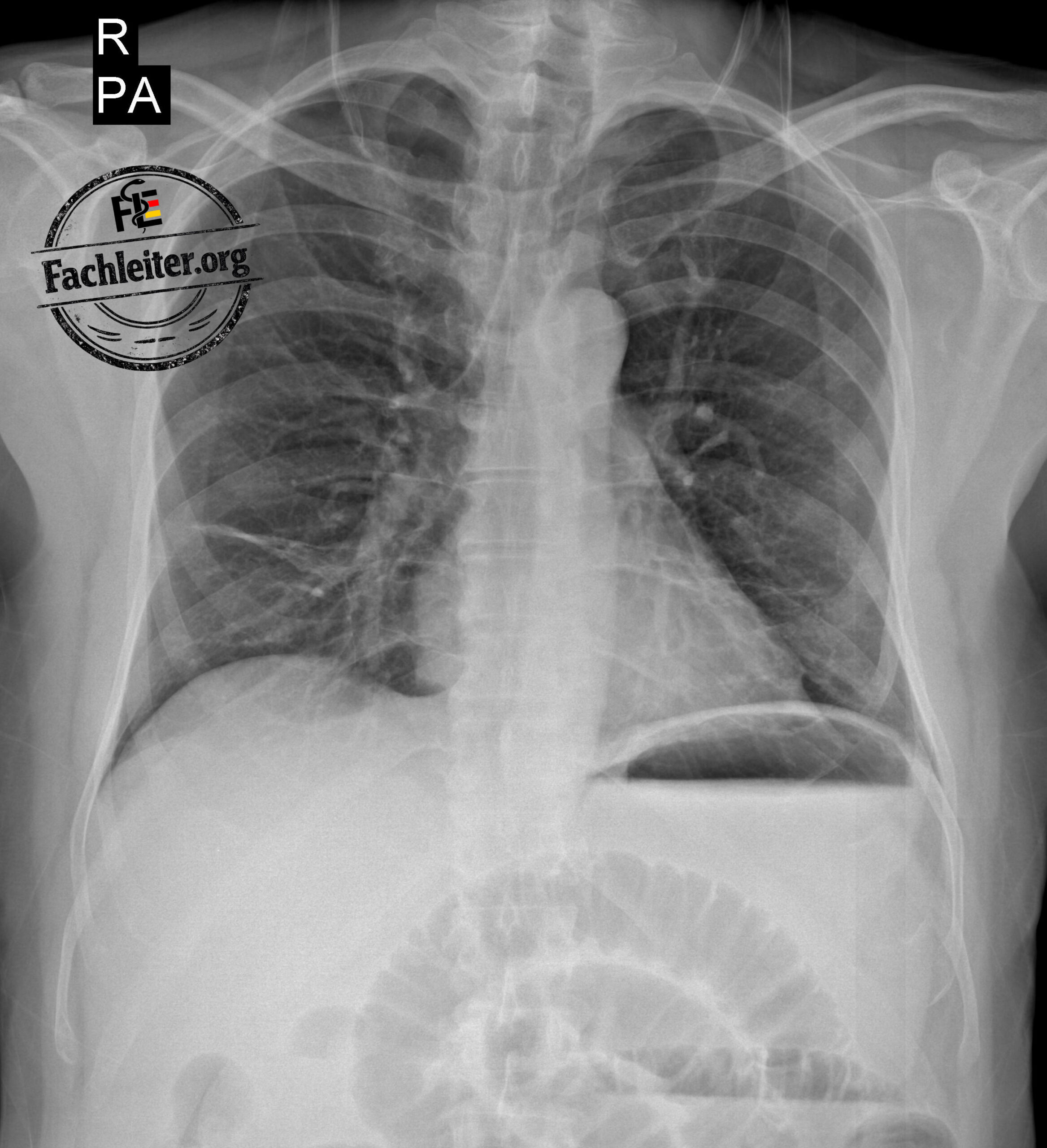 Thorax-Röntgen in p.a.-Projektion (stehend)