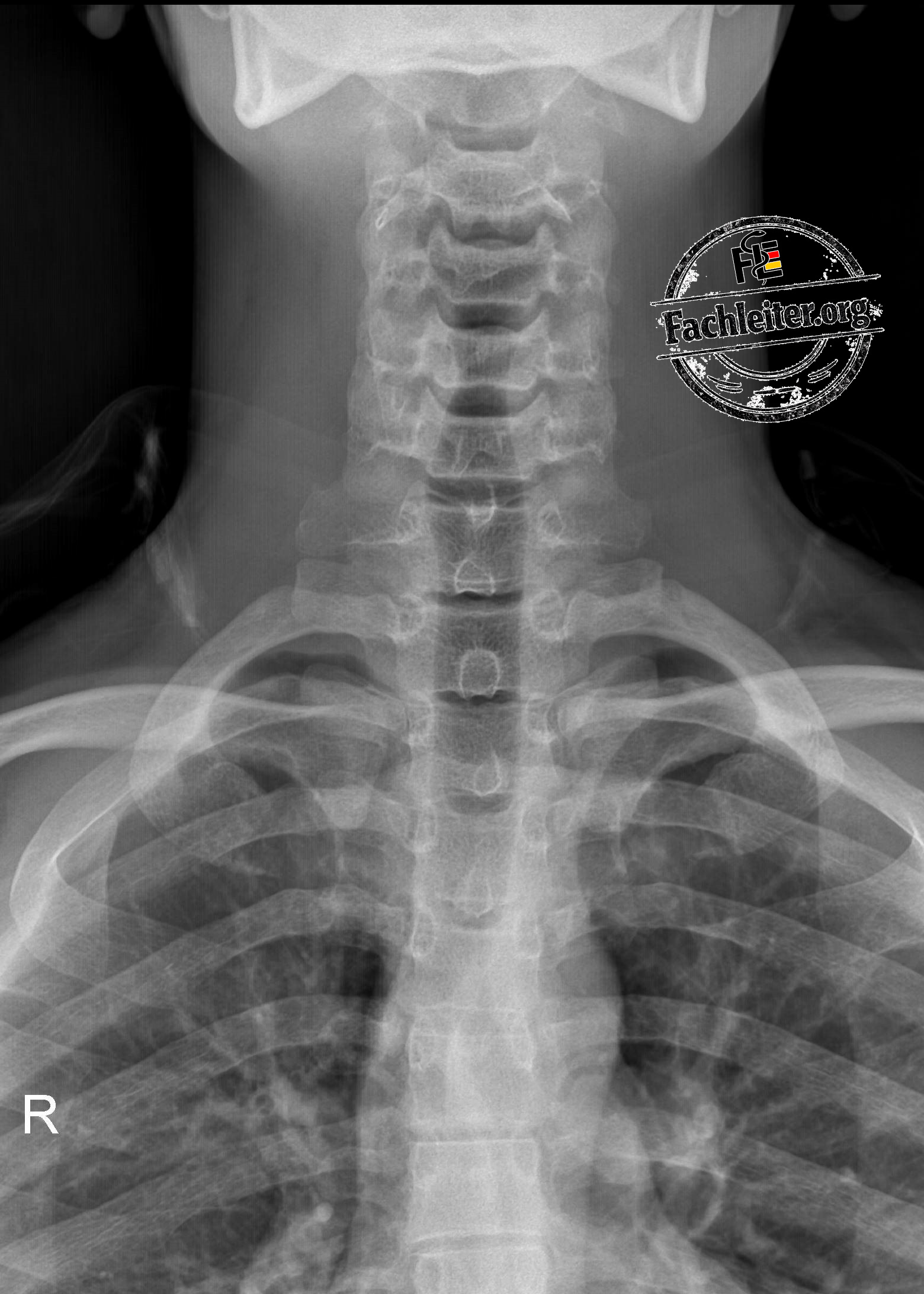 a.-p.-Aufnahme (anteroposterior)