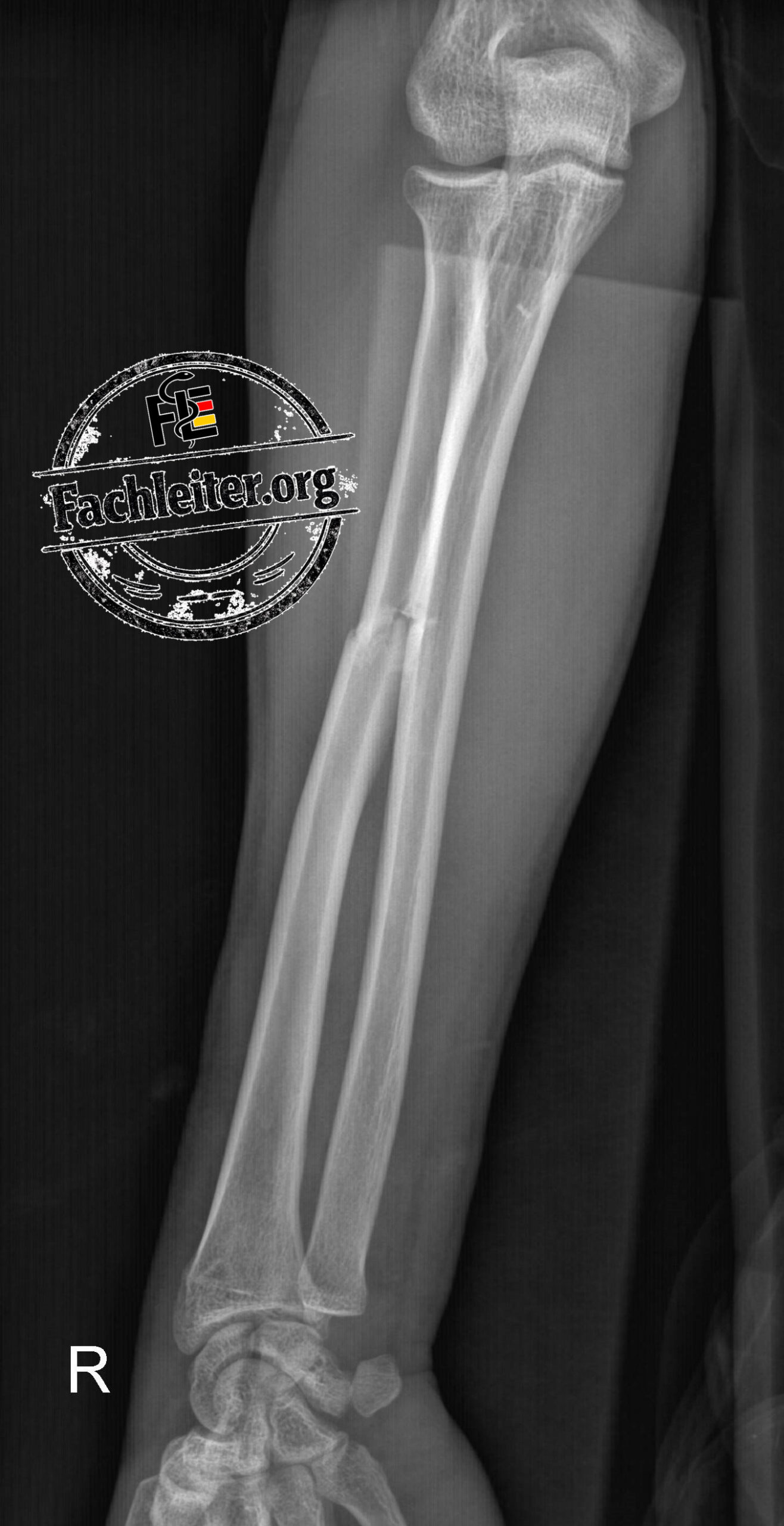AP (anteroposterior)