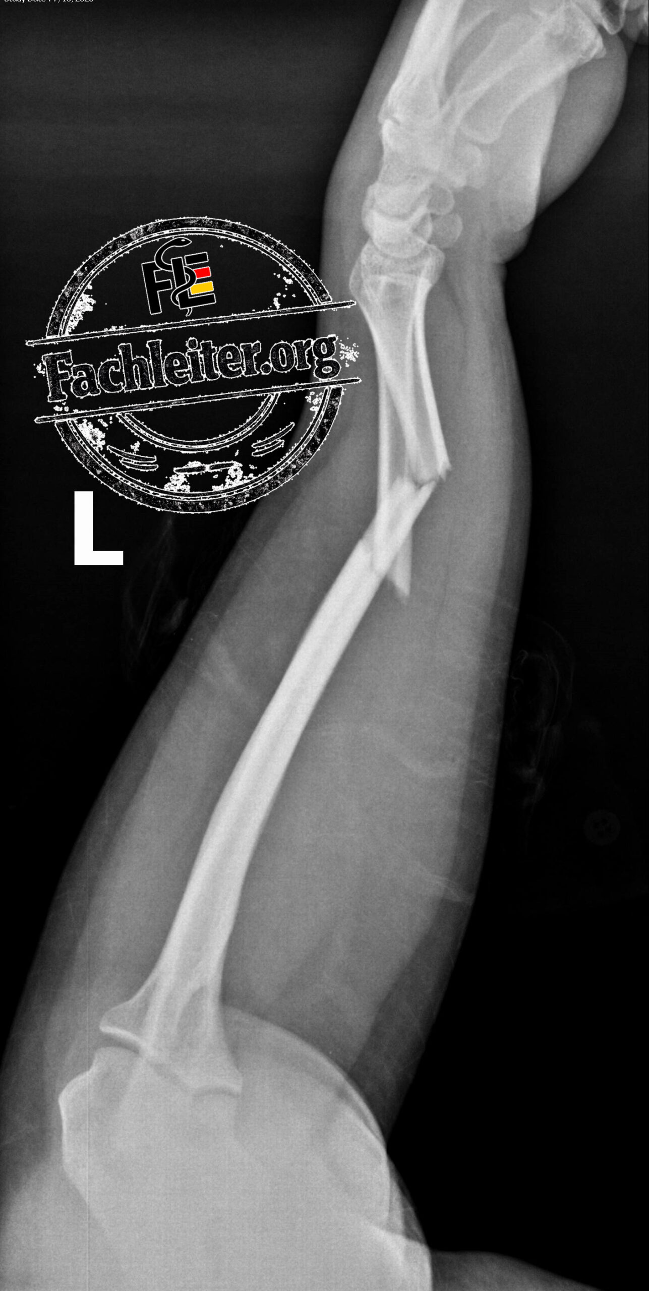 Lateral
