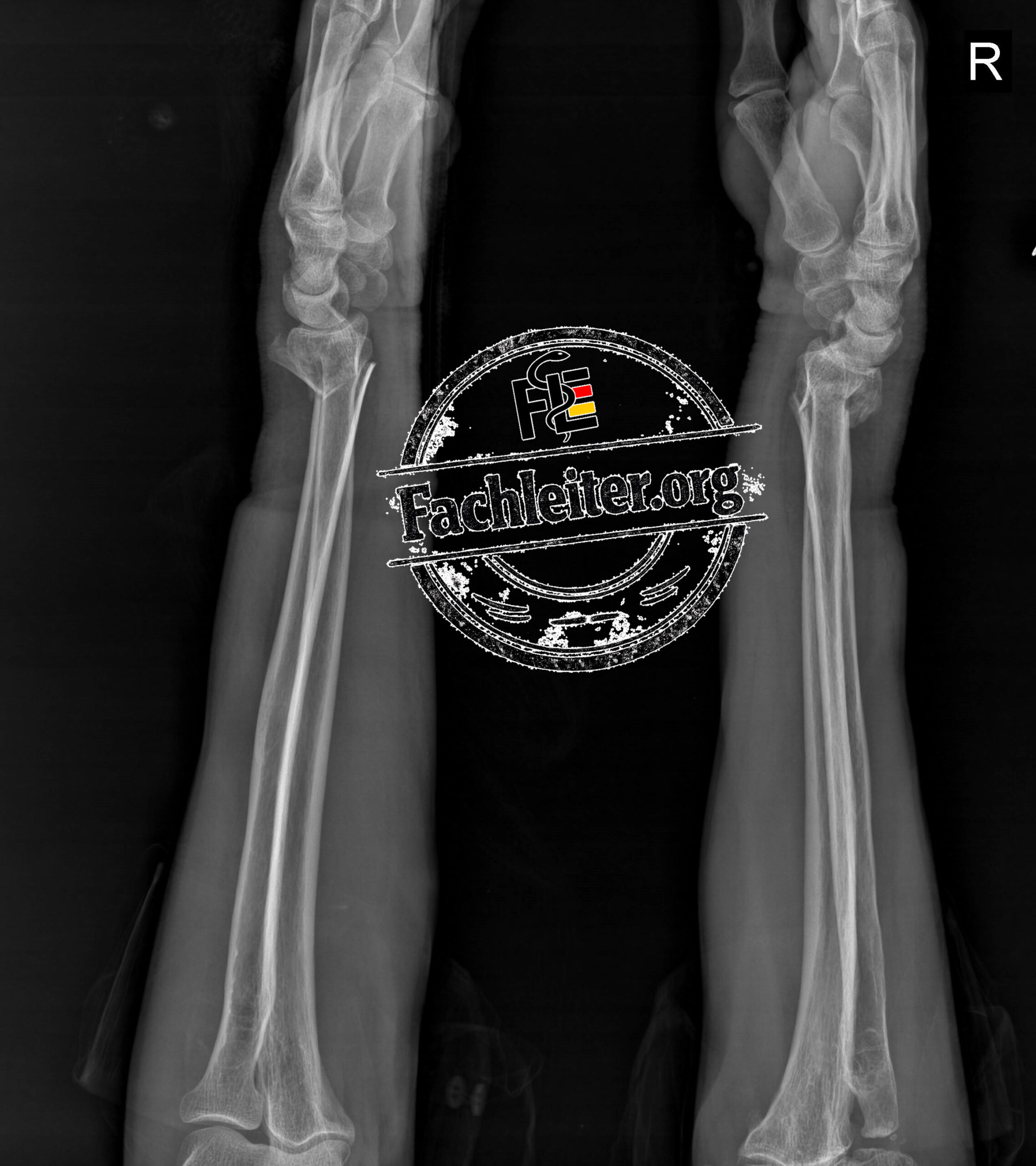 Lateral