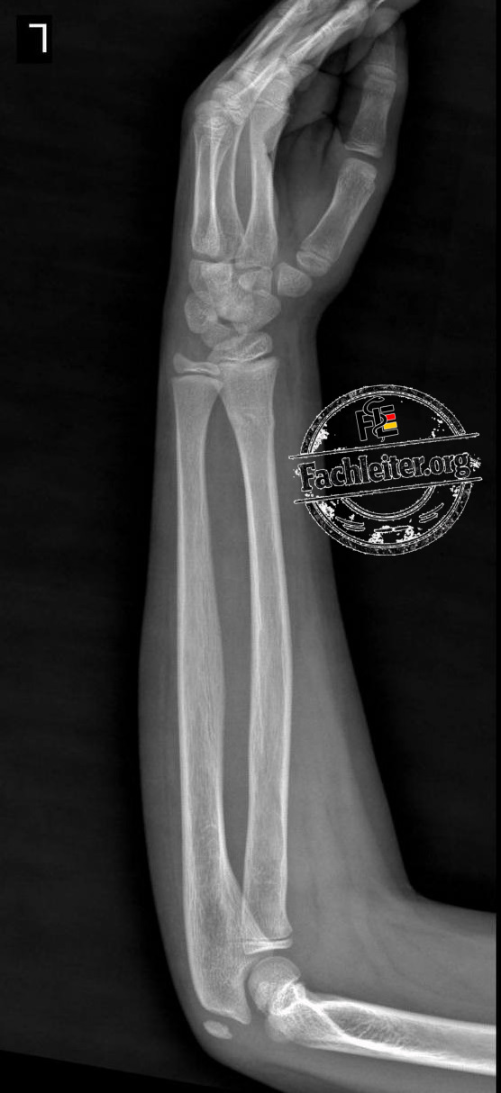 Lateral