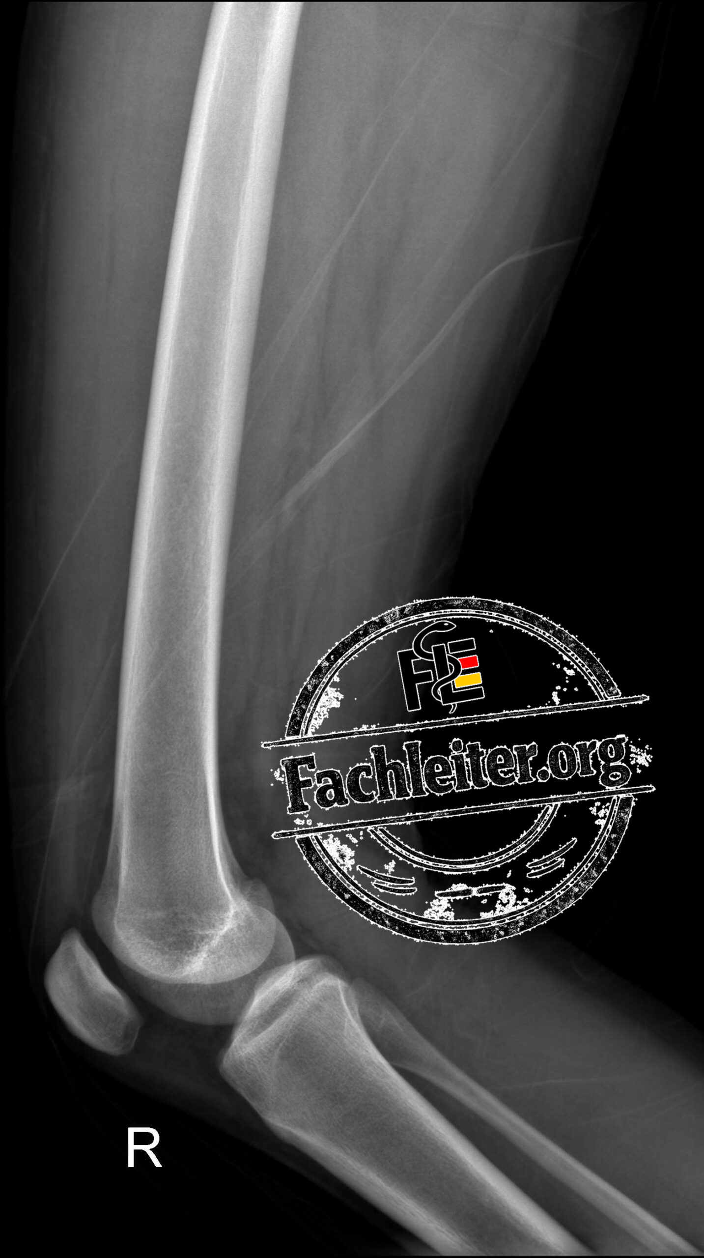 Lateral